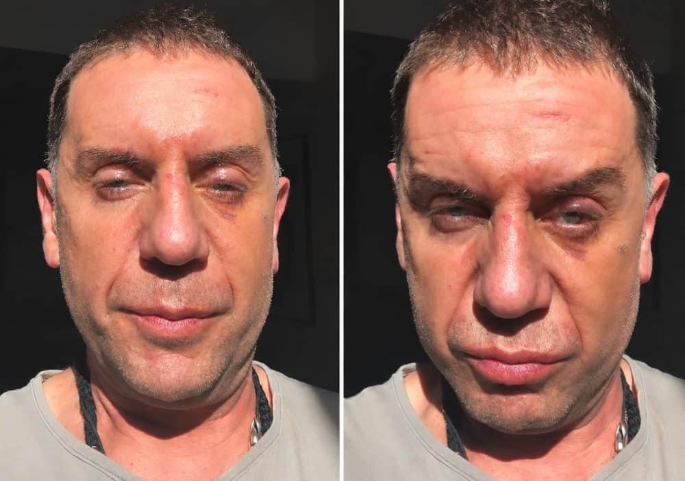 Γιώργος Μαζωνάκης: «Θα του κόψω το κεφάλι» – Ξεσπά για τους μώλωπες και το  μαυρισμένο του μάτι